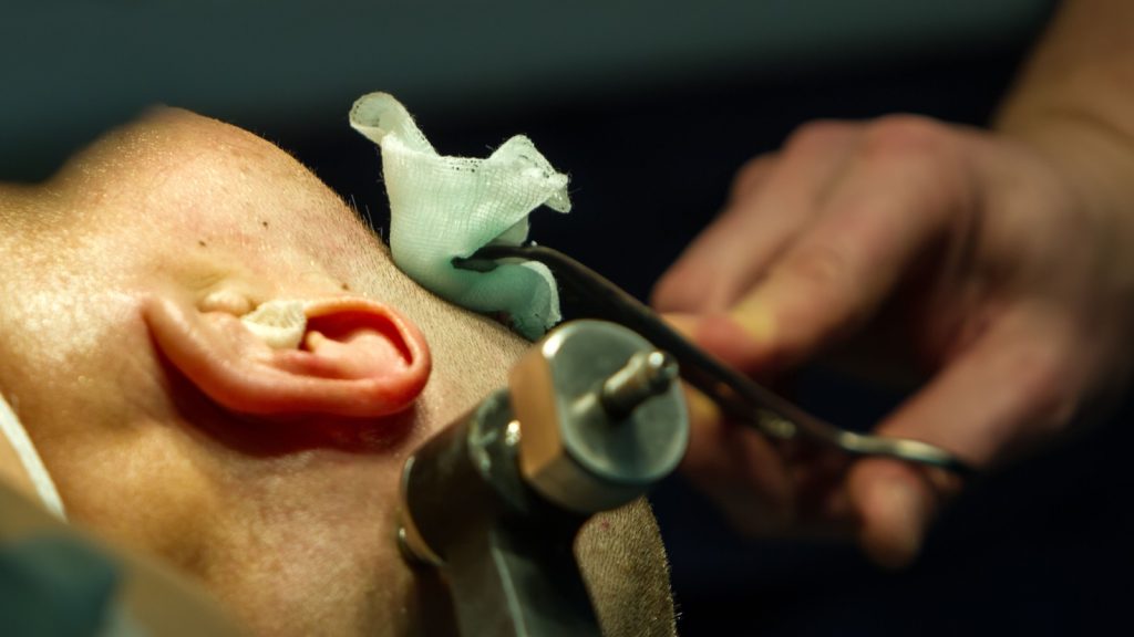 Trepanation of the skull