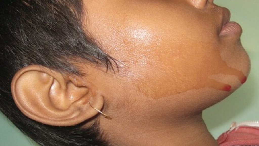 hematohidrosis. bleeding spontaneously from her eyes, scalp, and other parts of her body without any visible injury.