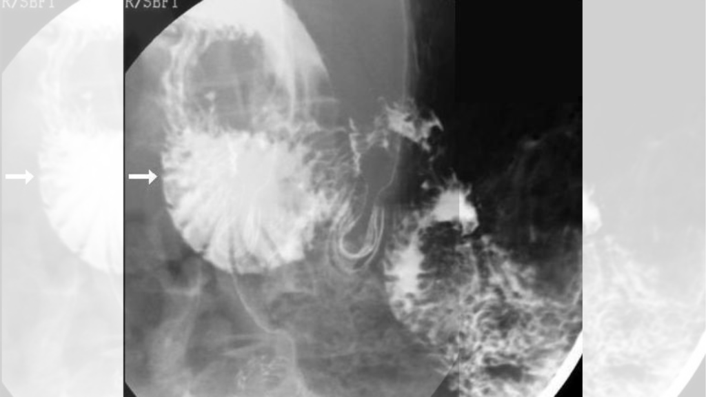 Superior Mesenteric Artery Syndrome