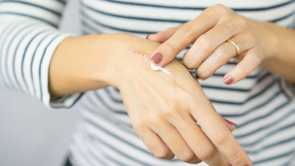 A woman applying scars removal cream to heal