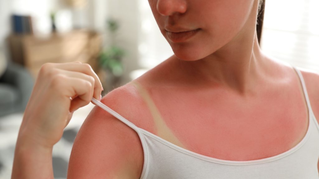 A woman with visible sunburn on her skin.