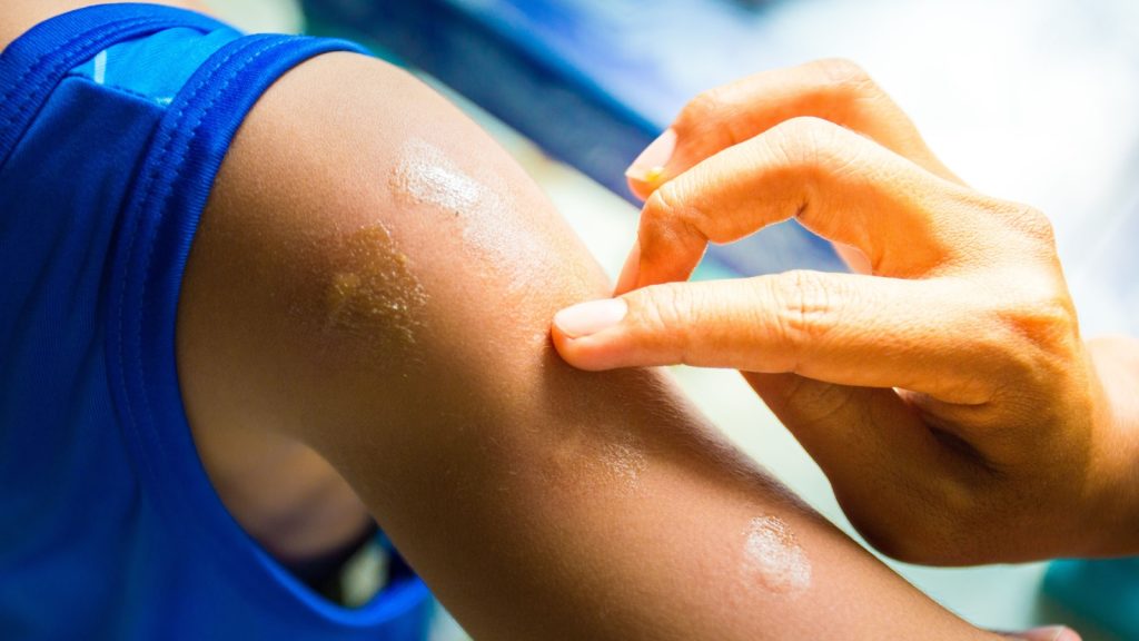 A person applying ointment to insect bites on the skin.