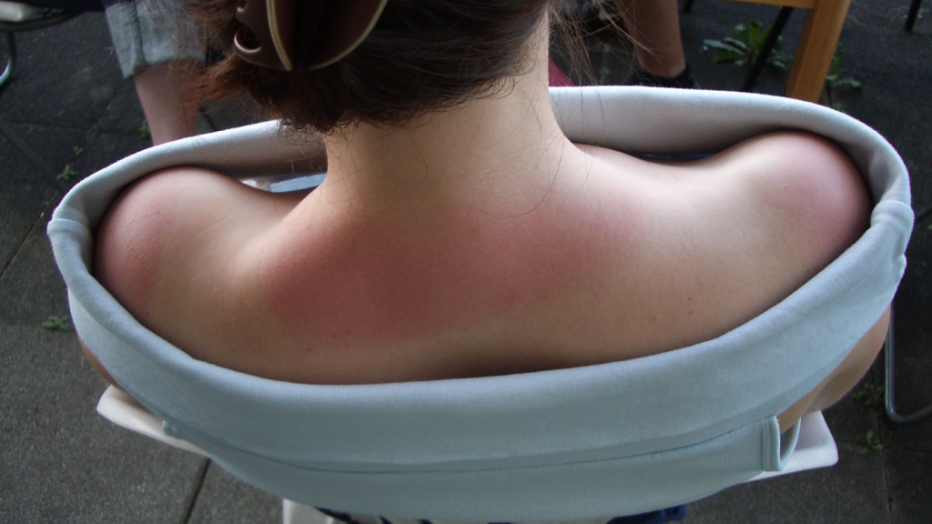 sunburnt neck and shoulder
