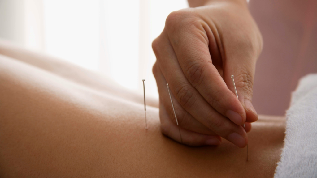 acupuncture
