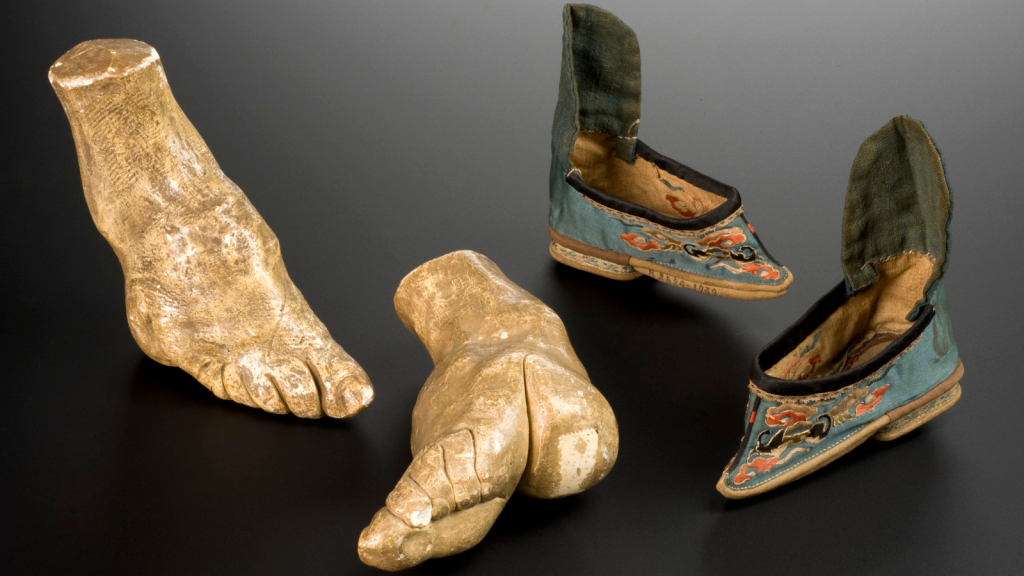 plastic model of deformed feet by food-binding
